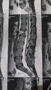 Ajude Aretusa a Caminhar Novamente: Doe para sua Cirurgia!