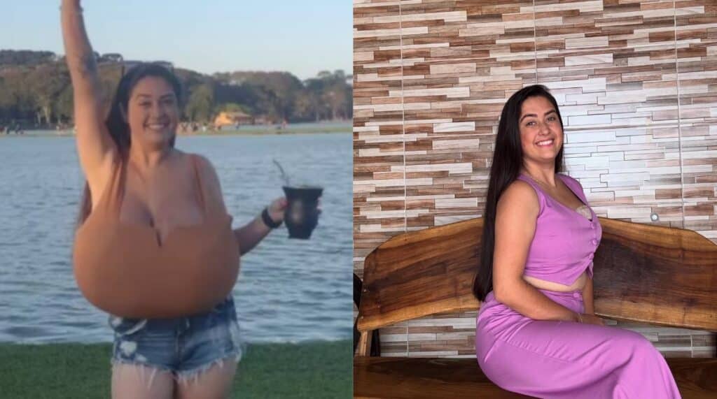 Jovem com mamas de 12kg realiza cirurgia após campanha solidária