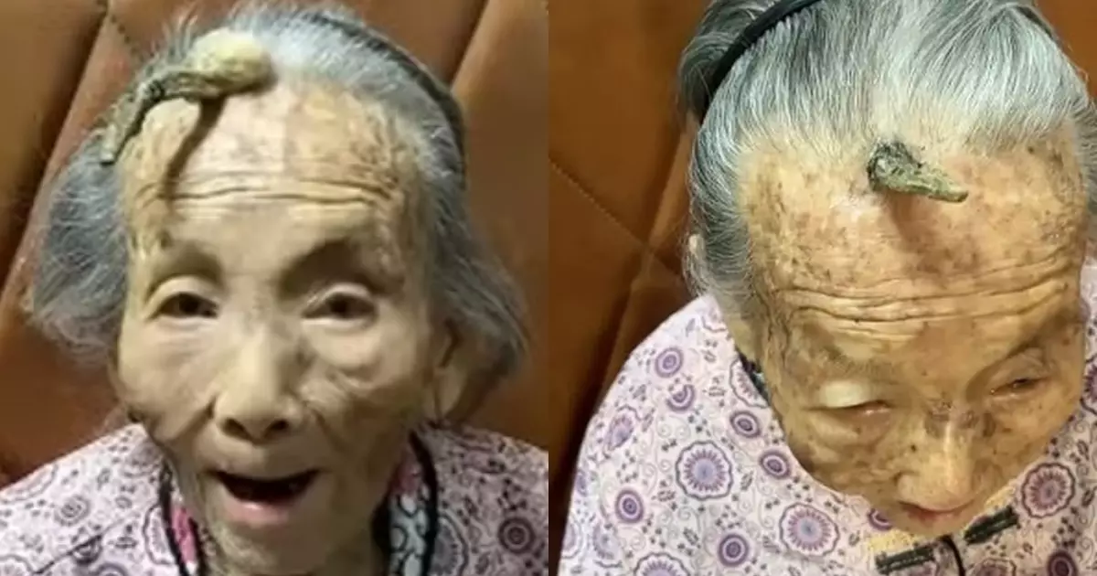 Idosa de 107 anos com chifre surpreende o mundo