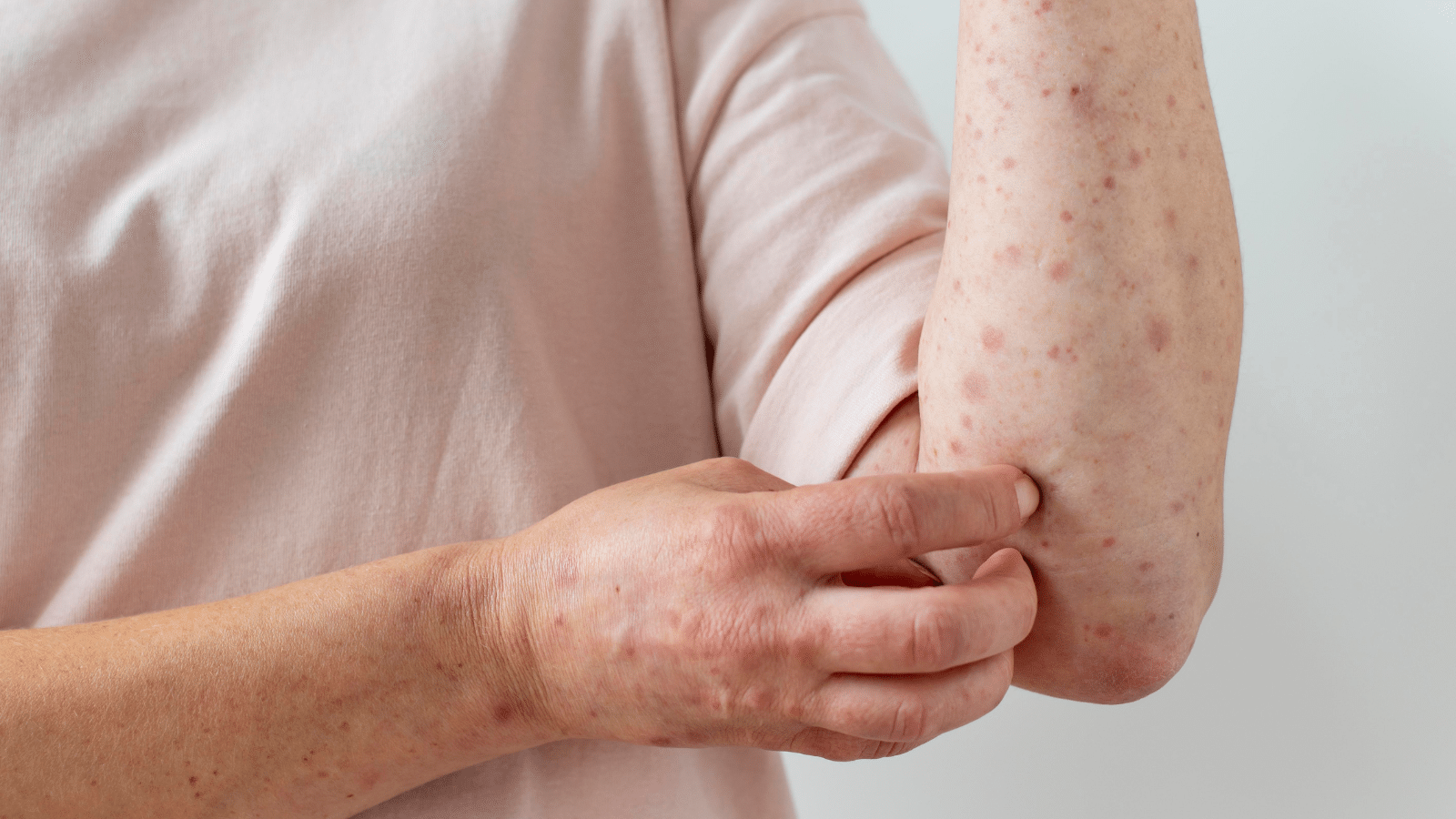 Mpox: sobe para 140 casos confirmados no Brasil neste ano