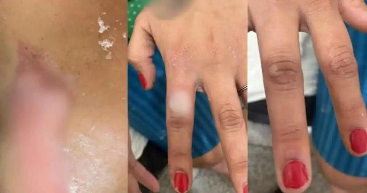 Homem queima mulher porque ela pintou as unhas
