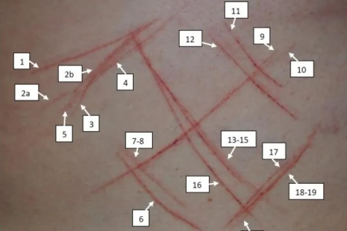 Perícia sugere automutilação no caso de jovem que teve corpo marcado por objeto cortante