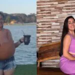 Jovem com mamas de 12kg realiza cirurgia após campanha solidária